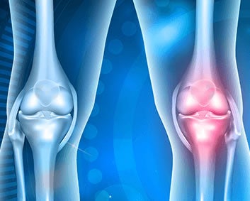 Osteoartrite uma doença das articulações: ilustração de articulações do joelho com característica de osteoartrite